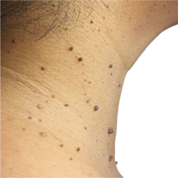 Skin Tags