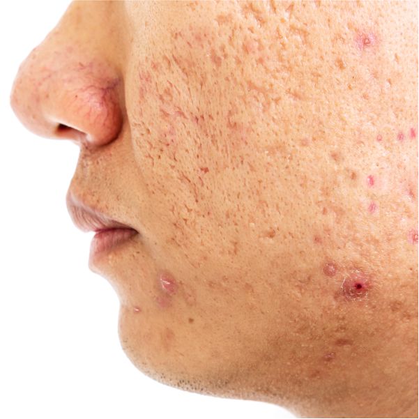 Acne scars