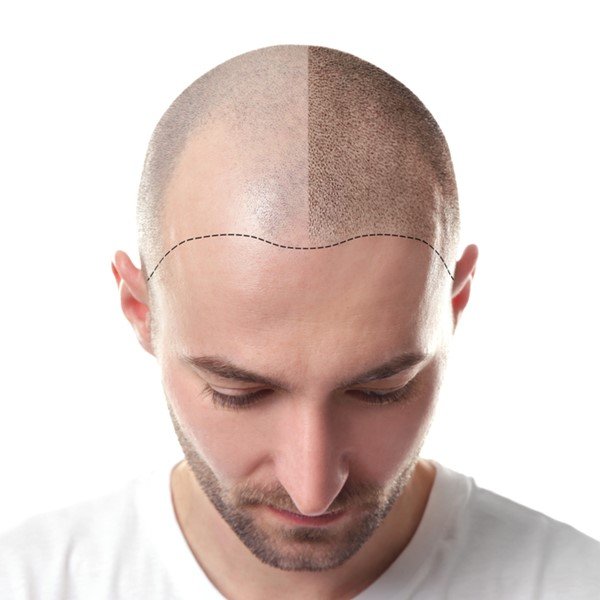 Scalp Micropigmentation