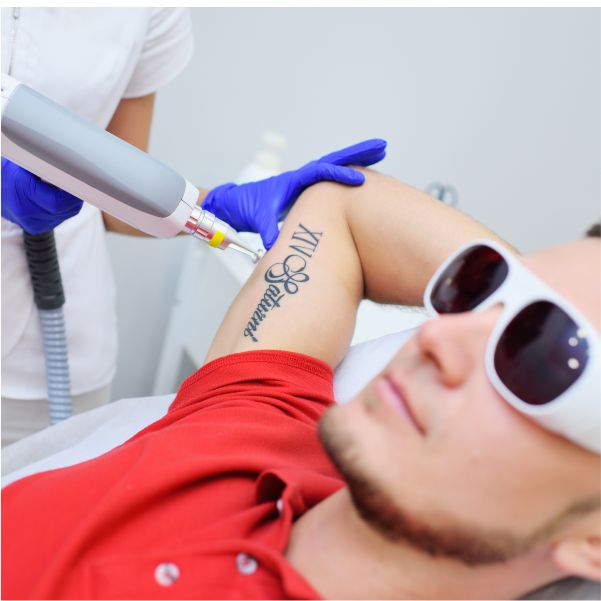 Tattoo Removal