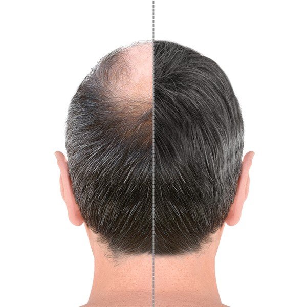 Hair Transplantation